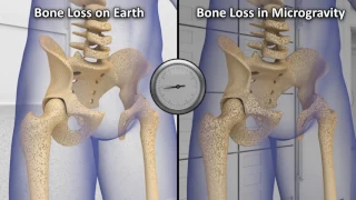 Bone Remodeling in Microgravity