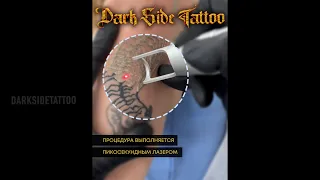 Удалить татуировку лазером в Воронеже