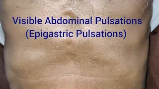 Clinical Examination: Visible Epigastric Pulsations