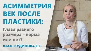 Асимметрия век после блефаропластики: что делать, если глаза стали разного размера?