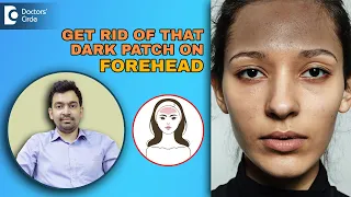 Get Rid of Black/Dark Forehead  | Pigmentary Demarcation Lines- Dr.Rajdeep Mysore | Doctors' Circle