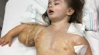 Toddler’s Rare “Hulk” Disease