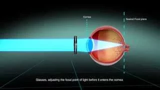 LaserFit Scleral Contact Lenses for complex vision problems