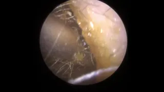 845 - Fully Blocked Sticky Ear Wax Removal