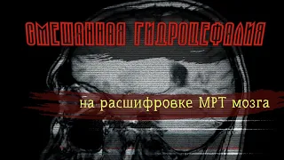 СМЕШАННАЯ ГИДРОЦЕФАЛИЯ у взрослых на РАСШИФРОВКЕ МРТ головного мозга. Пространства Робина Вирхова