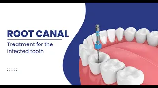 Root canal Treatment I Root canal #youtubeshorts #shorts #shortsyoutube