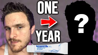 I Tried Differin For ONE YEAR & Here's What Happened!