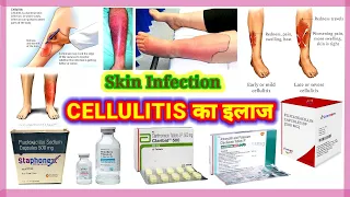 Cellulitis | Cellulitis Treatment | Cellulitis Of The Legs | Cellulitis Skin Infection | Dr. Vijay