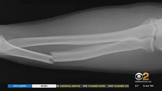 New Bandage Uses Stem Cells To Heal Broken Bones Faster