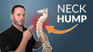 How To Correct Your NECK HUMP // Simple Stretch & Exercise