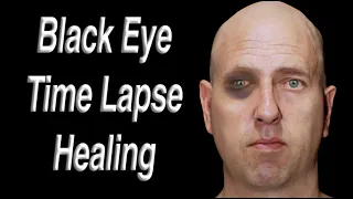 Black Eye Facial Trauma Time Lapse Healing