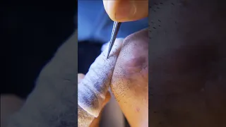 ingrown hair pull out speedx2 with tweezers!  Satisfying 238 #shorts #satisfying  #well  #removal