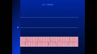 Lecture 6 : Understanding the pacemaker ( Pacemaker timing cycles  Part 2) - Dr. Emmanual Fares