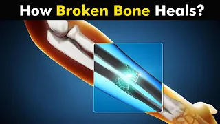 Process of Bone Healing | Bone Healing Steps (Urdu/Hindi)