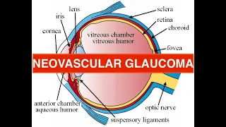 neovascular glaucoma - etiology, causes, course, treatment