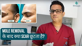 Scar after Mole Removal | Mole surgery in Delhi | Mole removal by Laser | SkinQure | Dr. Jangid