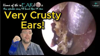 VERY CRUSTY EARS 241 #ear #earwax #earwaxremoval #earcleaning #fyp  #asmr #asmrearwax #satisfying