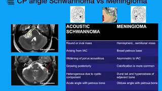 CP Angle tumors- Schwannoma -Meningioma