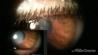 Blunt trauma case 1(corneal edema by pellet)