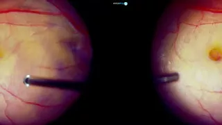 3D Surgery: Traumatic Macular Hole: Dr. Manish Nagpal