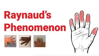 Raynaud's Phenomenon :- Causes and Types, Clinical Features, Diagnosis and it's Management