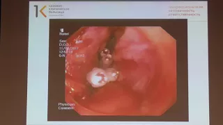 01 Мелкомуков ВА Эндоскопическое ушивание разрыва пищевода после бужирования рубцового стеноза