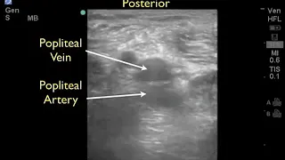 How to Case Study  Deep Vein Thrombosis Detection with Ultrasound Part 2   SonoSite, Inc1