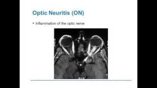 Visual Involvement in MS: Optic Neuritis and Optical Coherence Tomography