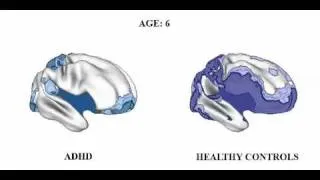 Brain matures a Few Years Late in ADHD, but follows Normal pattern