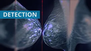 Mammographie de dépistage : la détection