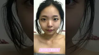 [Plastic Surgery in Korea] 3 type facial contouring from DA Clinic