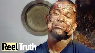 The Man Covered in Boils: Hidradenitis Suppurativa | Medical Documentary | Reel Truth