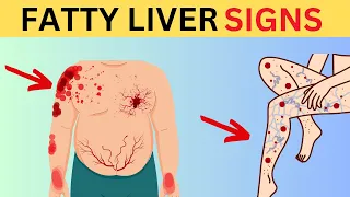 A Silent Threat: 8 Alarms That Could Indicate Fatty Liver Disease | Stay Healthy