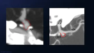 Microsurgical Clipping of a Posterior Communicating Artery Aneurysm Presented with CN III Palsy