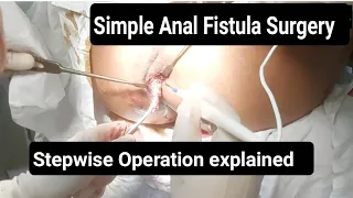 Simple Anal Fistula Surgery Procedure | Surgeon Dr Imtiaz Hussain