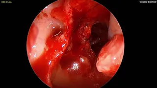 Parasellar Meningioma Endoscopic