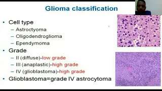 "Long Term Management of Gliomas" by Gaafer Alhaj MD