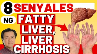 8 Senyales ng Fatty Liver, Liver Cirrhosis. - By Doc Willie Ong (Internist and Cardiologist)