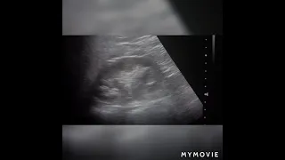 Mild hydronephrosis | ultrasound case