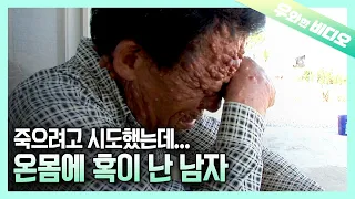 얼굴부터 몸 전체에 뒤덮은 섬유종으로 고통받는 남자┃A Man Suffering From Fibroids That Cover His Body and Face