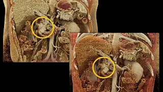 CT of Small Bowel Tumors: Detection & Classification  Part 2