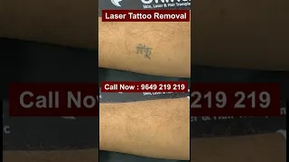This Is Why Laser Tatto Removal Is So Famous! #tattoo_removal #tattoremoval #shorts  #skinaaclinic