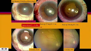 SYM47 09   Endophthalmitis  Prophylaxis and Management   Cases and Cases in Endophthalmitis