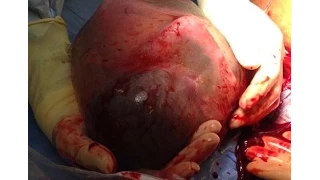 Baby born still INSIDE his amniotic sac is hailed a 'medical miracle' by doctors