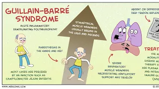 GBS(Gillian Barre Syndrome) by Dr Gireesh Kumar KP