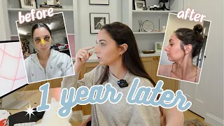 The Truth About My Rhinoplasty (1 year later...)