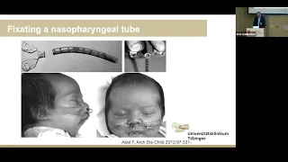 Treatment of Infants with Robin Sequence and Other Craniofacial Malformations