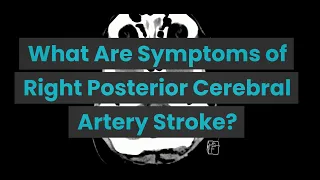 What Are Symptoms of Right Posterior Cerebral Artery Stroke?