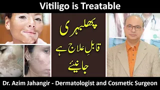 Vitiligo (Phulbehri) is Treatable In Pakistan |Treatment Procedures| With Prof.Dr.Azim Jahangir Khan