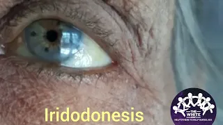 Iridodonesis #Clinical Signs #shorts #Subluxation of Lens